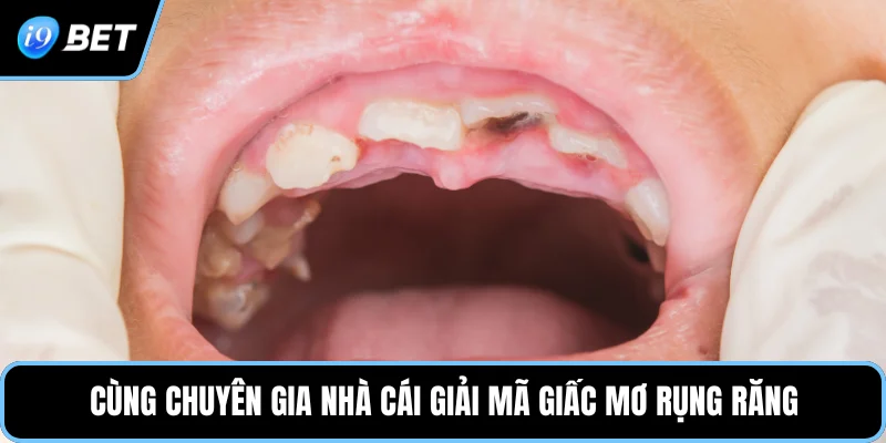 Cùng chuyên gia nhà cái giải mã giấc mơ rụng răng